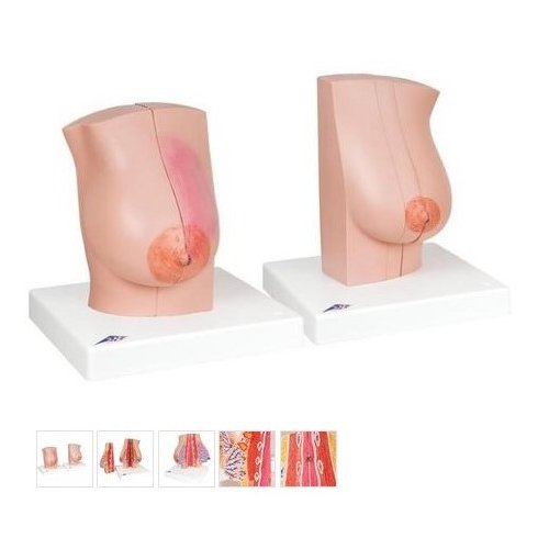 Model ženského prsu s onemocněním